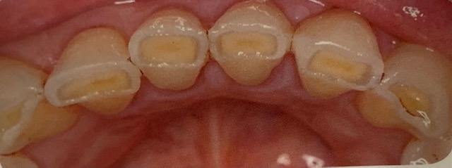 酸蝕歯 神保町ガーデン歯科