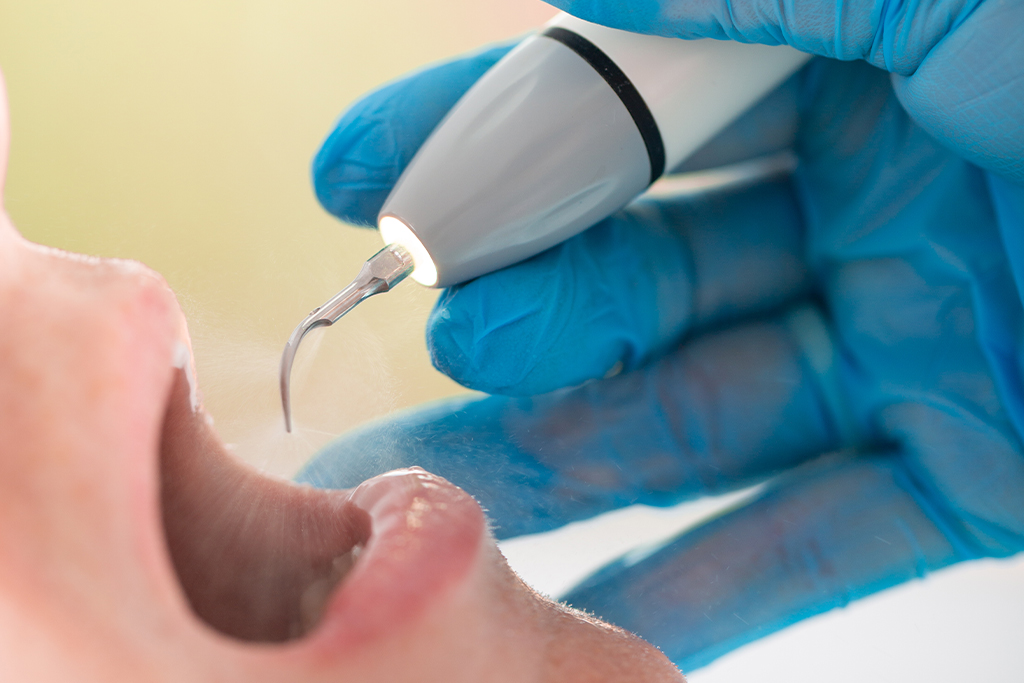 神保町・神保町ガーデン歯科・４．スケーリング