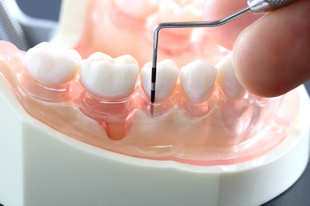 神保町・神保町ガーデン歯科・歯周病治療
