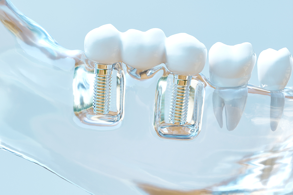 神保町・神保町ガーデン歯科・インプラント