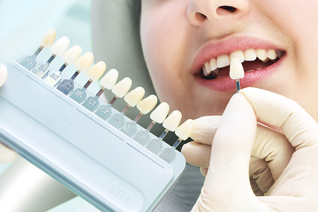 神保町・神保町ガーデン歯科・オフィスホワイトニング