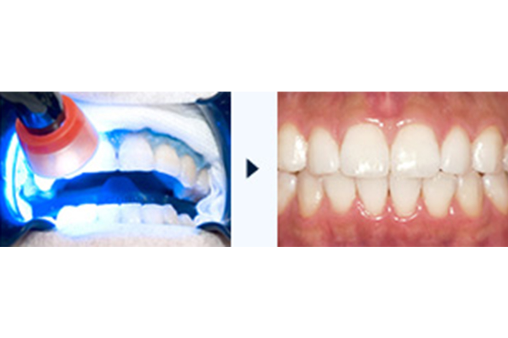 神保町・神保町ガーデン歯科・日本人の歯質に合わせて開発された「Tion(ティオン)」